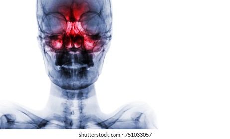 Sinusitis At Frontal , Ethmoid , Maxillary Sinus . Film X-ray Of Skull And Blank Area At Right Side