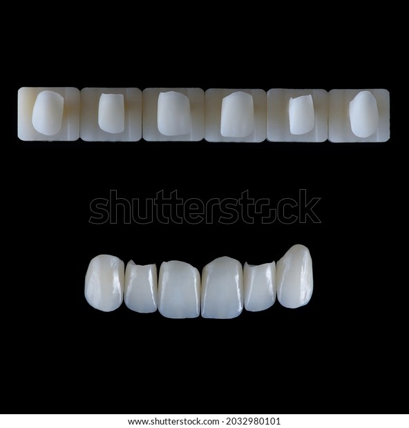Six\
upper jaw frontal ceramic crowns prosthesis on black glass\
background. Artificial jaw with veneers and\
crowns.