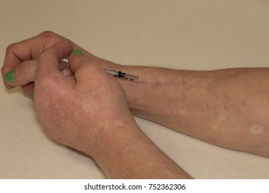 Sixty Year Old Woman Intravenous Drug Addict With White Scarring From Crack Cocaine And Dark Scars From Heroin Use