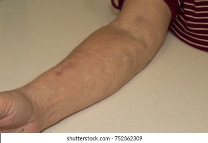 Sixty Year Old Woman Intravenous Drug Addict With White Scarring From Crack Cocaine And Dark Scars From Heroin Use