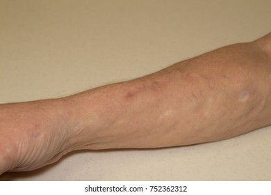 Sixty Year Old Woman Intravenous Drug Addict With White Scarring From Crack Cocaine And Dark Scars From Heroin Use