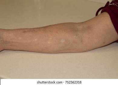 Sixty Year Old Woman Intravenous Drug Addict With White Scarring From Crack Cocaine And Dark Scars From Heroin Use