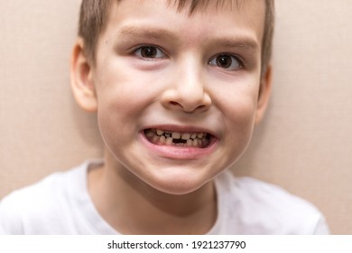 a six-year-old boy shows missing teeth. close-up portrait