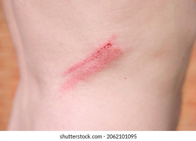 Skin Abrasion Or Graze On A Man's Back. Medical Graze, Injury Or Wound, UK