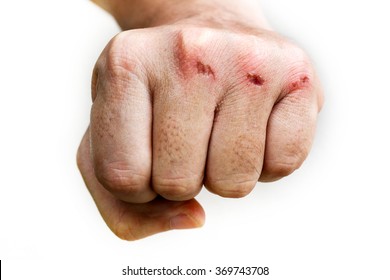 skin abrasion injury on the knuckles of the left hand