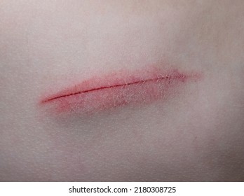 Skin Abrasion Or Scratch On The Abdomen. Medical Abrasion, Injury Or Wound High Quality Photo