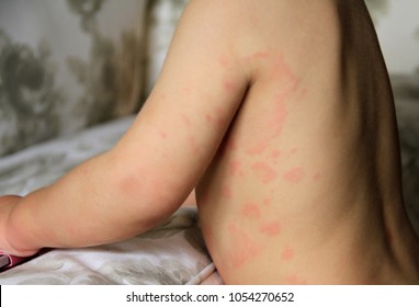 The Skin Of An Allergic Child Or Hives Is A Rash.