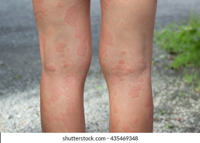 Skin Allergies, Legs Skin Women.