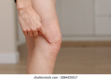 skin allergies, legs skin women. Closeup of red pustules on a knee, an allergic reaction caused by atopic dermatitis. Selected focus.