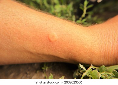 Skin allergy, allergic.
				Yellow wasp : stung by a wasp worker.
				Yellow hornet stings a man's arm.
				It's also called a German wasp or European wasp.
				Yellowjacket or yellow jacket.
				Wasps, insects, insect