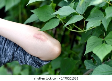 Skin Allergy Diseases Problem, Poison Tree Contact Dermatitis Rash, Female Dermatology Patient With Allergic Eczema On Arm, Allergic Heal By Herbal Natural Plant.