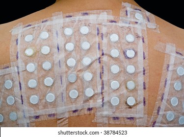 Skin Allergy Patch Test On Back Of Female Patient