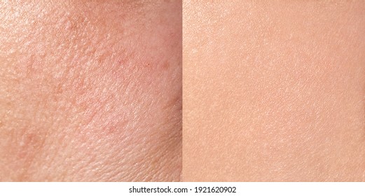 Skin Before And After Treatment, Close-up, Square Format, Horizontal