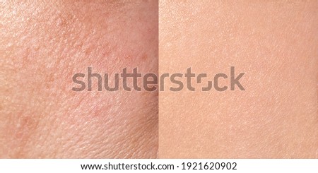 Skin before and after treatment, close-up, square format, horizontal