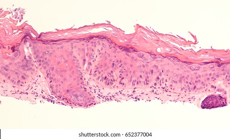 150 Actinic keratosis Images, Stock Photos & Vectors | Shutterstock