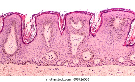 Skin biopsy micrograph of pigmented seborrheic keratosis, a benign wart-like growth, associated with aging, with hyperkeratosis and "horn cysts". Clinically, they appear to be "pasted on".