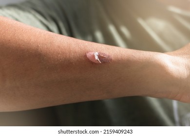 Skin Burn: Burns And Scalds - Superficial Second Degree Burn, Skin Grafting And Donor Site