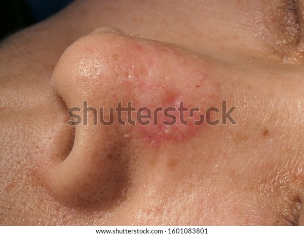 skin cancer with\
basal cell carcinoma on\
nose