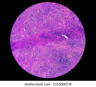 Skin Cancer: Skin Biopsy Under Microscope Showing Basal Cell Carcinoma.