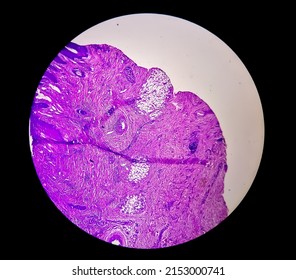 Skin Cancer: Skin Biopsy Under Microscope Showing Basal Cell Carcinoma.