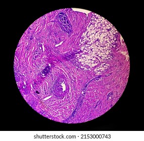 Skin Cancer: Skin Biopsy Under Microscope Showing Basal Cell Carcinoma.