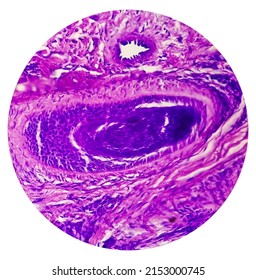 Skin Cancer: Skin Biopsy Under Microscope Showing Basal Cell Carcinoma.