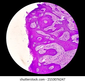 Skin Cancer: Skin Biopsy Under Microscope Showing Basal Cell Carcinoma.