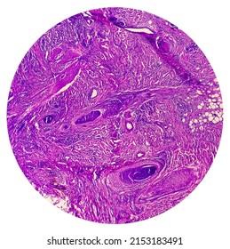 Skin Cancer: Skin Biopsy Under Microscope Showing Basal Cell Carcinoma.