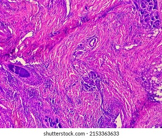 Skin Cancer: Skin Biopsy Under Microscope Showing Basal Cell Carcinoma.