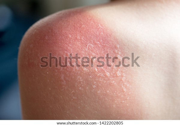 Skin care concept. guy got sunburn and got tan\
lines on his shoulder. The skin sloughs off its his burn skin. It\
is the cause of melanoma. He has a burning pain on his shoulder.\
Step by step.