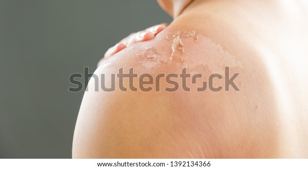 Skin care concept. Handsome guy got sunburn and got\
tan lines on his back. The skin sloughs off it is burn skin. It\
looks ugly. He has a burning pain on his shoulder. He get burning\
pain. Copy space