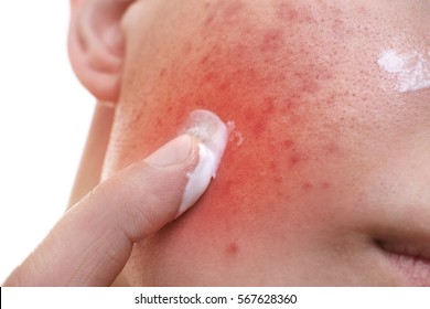 Skin Care Concept. Young Man Applying Acne Treatment Cream, Closeup