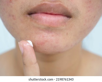 Skin Care Concept. Young Woman Applying Acne Treatment Cream, Closeup Photo, Blurred.