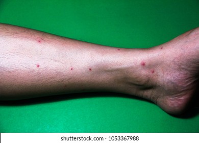 Skin Chemical Allergiesrashes On Legs Green Stock Photo 1053367988 ...