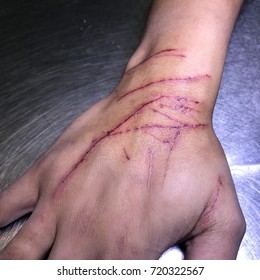 The Skin Condition After Cat Scratch And Bite Of Veterinary Surgeon Hand During Physical Examination In A Veterinary Clinic