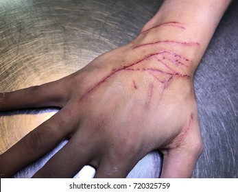 The skin condition after cat scratch and bite of veterinary surgeon hand during physical examination in a veterinary clinic - Shutterstock ID 720325759
