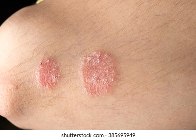 Skin Disease Psoriasis Closeup