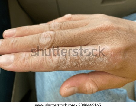 Skin diseases characterized by itching and dryness of the skin.