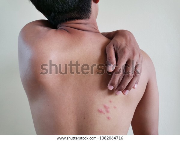Skin\
diseases. A man scratching his back. Painful back skin rash with\
blisters in a limited area. Heat rash, prickly heat and miliaria.\
It affects especially during hot or humid\
weather.