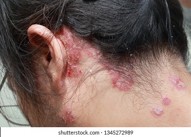 Skin Diseases Psoriasis Dermatitis