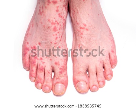 Skin disorder as hives. Human legs with  rash isolated on white. 