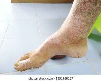 1,463 Scleroderma Images, Stock Photos & Vectors | Shutterstock