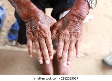 Skin disorder, pepper appearance from scleroderma, autoimmune disease male hand Skin disorder pepper appearance from vitiligo,scleroderma  raynaud, medical concept autoimmune disease. Skin disorder,
