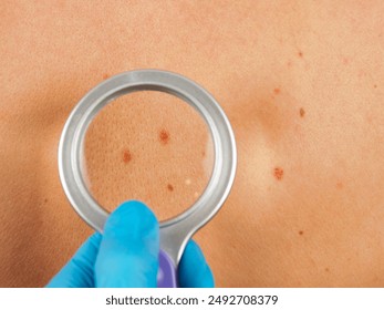 Skin examination by a dermatologist: examination of moles and formations to diagnose and evaluate the condition of the skin. - Powered by Shutterstock