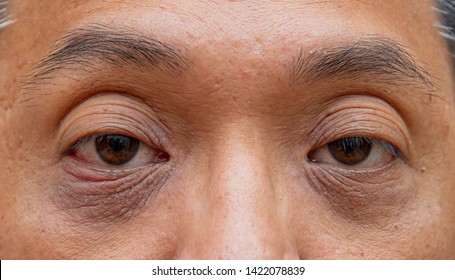 Skin Face Problem Of Asian Man 40s, Age  .Middle Aged Man Has Under Eye Dark Circles