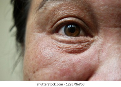 Skin face problem of asian woman 40s,as under eye dark circles,as crow’s feet, and melasma freckles due to pigment melanin malfunction due to hormones,and of Middle aged woman.Selective focus.
