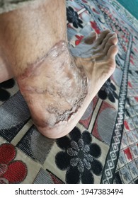 Skin Graft At Ankle After 3 Months. 