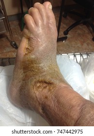 Skin Graft Leg