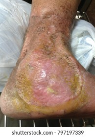 Skin Graft Wound Foot