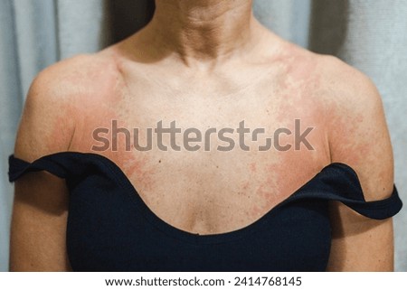 Skin health problem. Close-up woman's breast with allergy rash. 